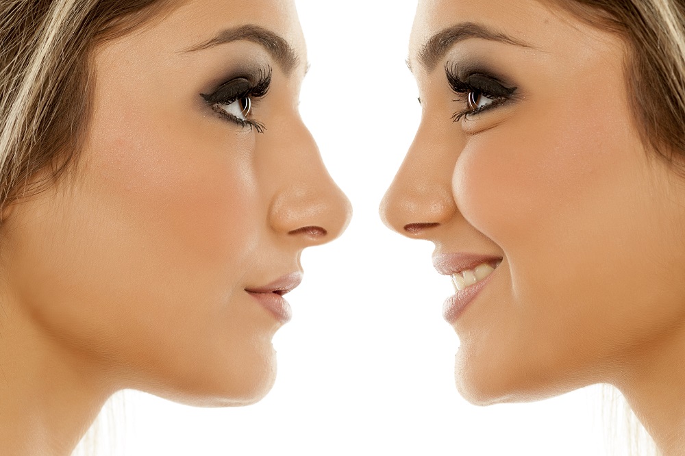 Factors To Consider Before Going For Nose Augmentation