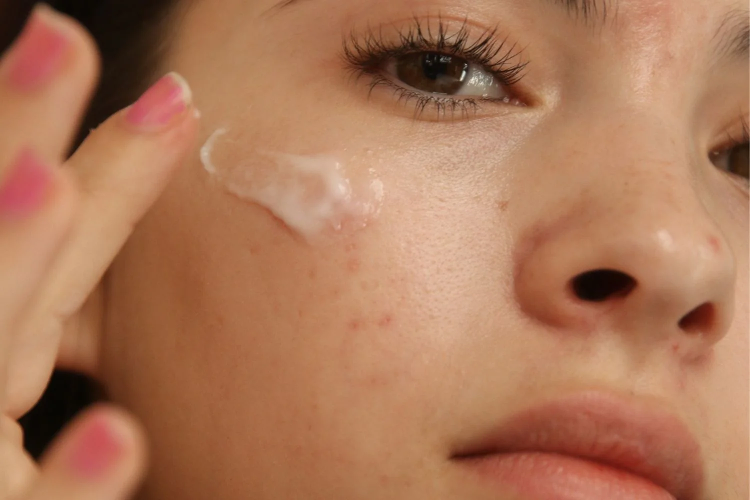 What is the difference between pimples and acne?