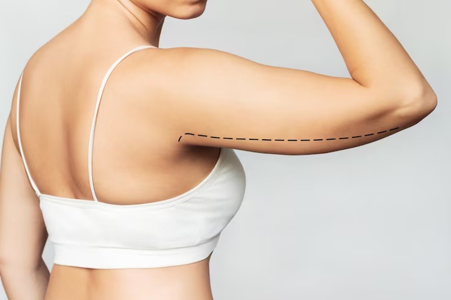 Types of Arm Liposuction and Things to Think About Before the Procedure