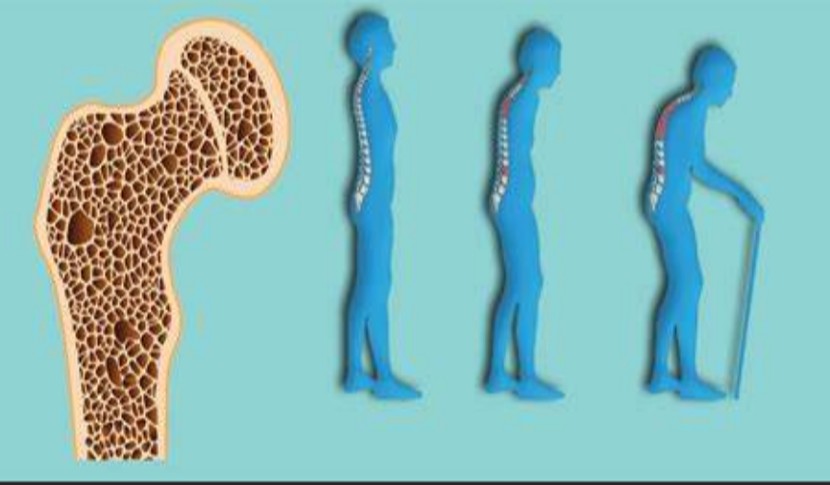 Unraveling the Fragile Bones: Exploring the Role of Mouse Models in Osteoporosis Research