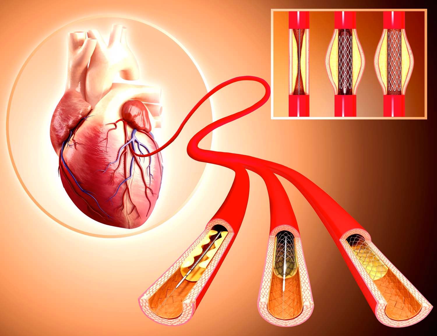 Atherosclerosis Procedures: Angioplasty and Stent Placement