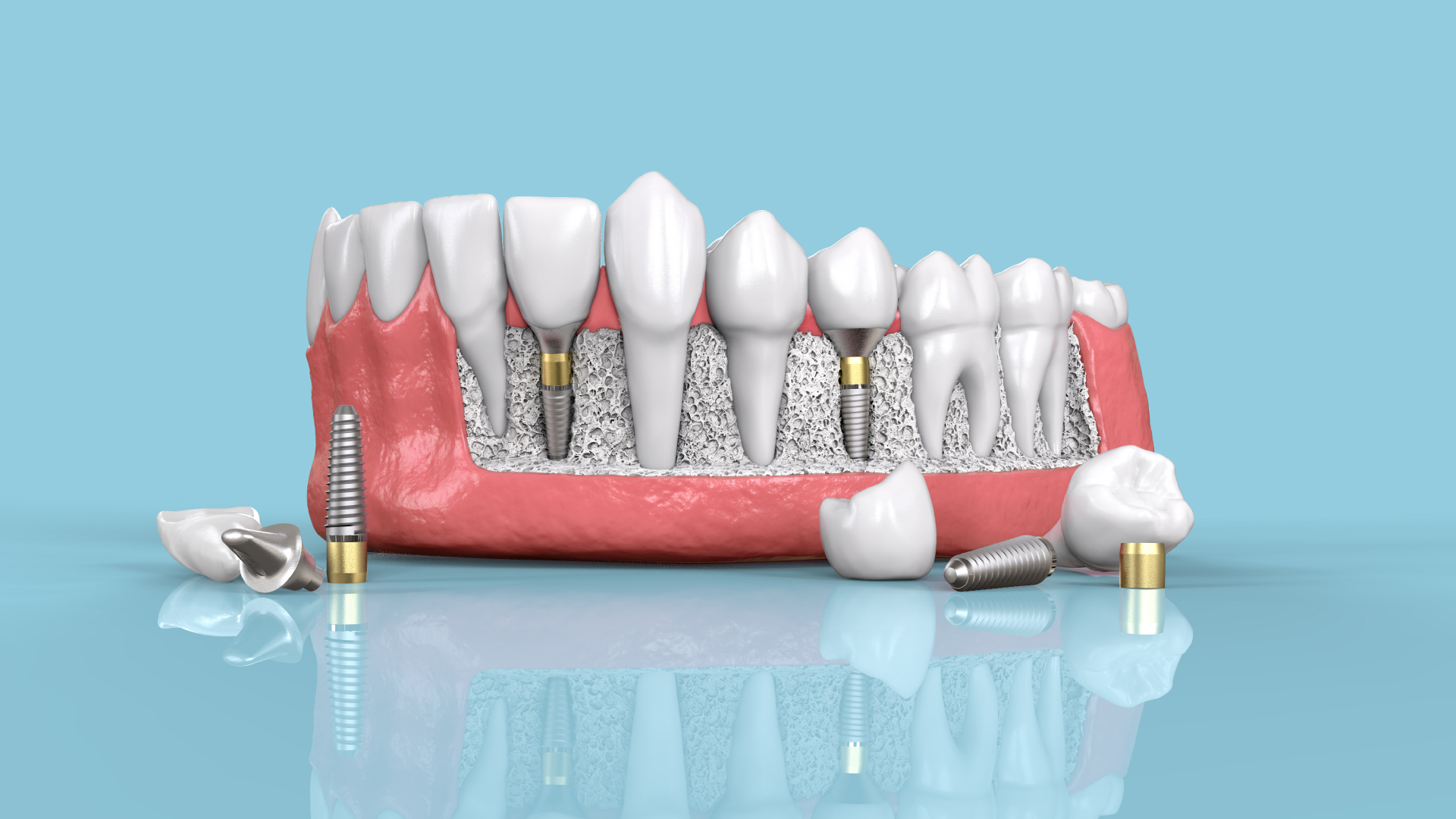 Beyond Dentures: The Evolution of Dental Implants in Edinburgh