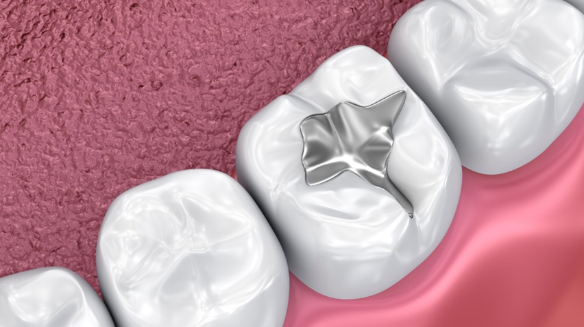 Dental Filling Material