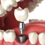 What to Look for When Buying Collagen with Dermaval